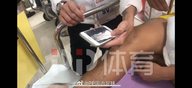 Hình ảnh chụp X-quang xương bàn chân bị gãy của trung phong mang áo số 9 của U23 Trung Quốc