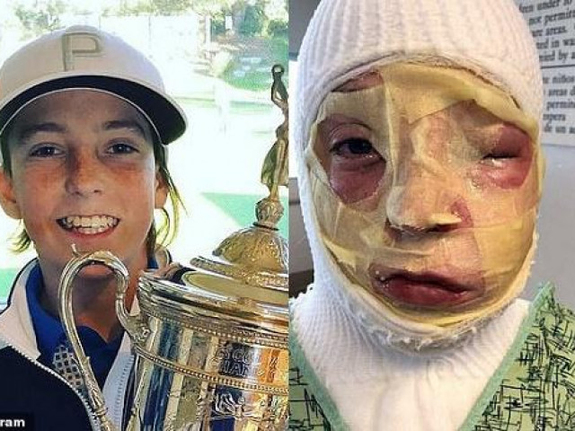 Giáo dục - du học - Nam sinh bị biến dạng hoàn toàn khuôn mặt vì thí nghiệm mang tên "rắn các bon"