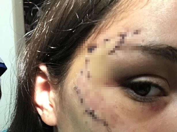 Lara phải khâu tới 40 mũi trên mặt sau vụ việc