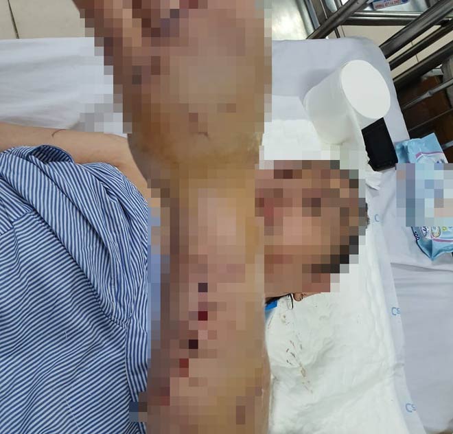 Chị Đ.T.V thời điểm đang điều trị tại bệnh viện.