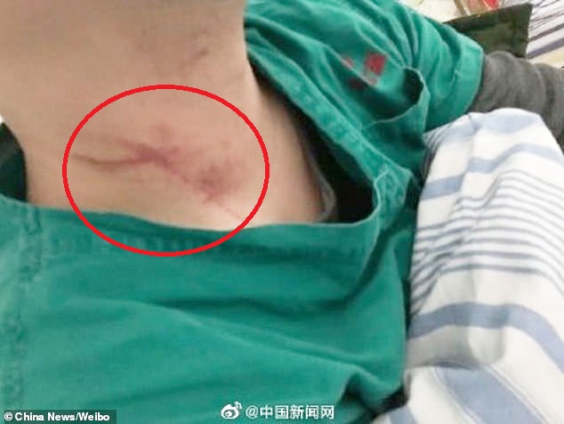 Hình ảnh được báo chí địa phương chia sẻ cho vết thương trên cổ bác sĩ bị người đàn ông hành hung