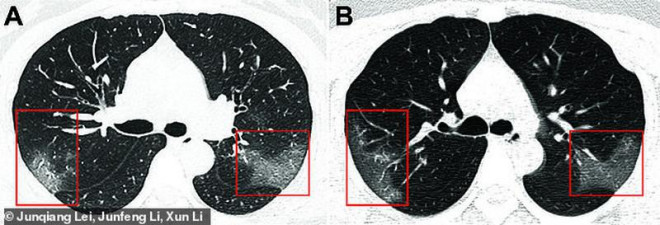 Thấy gì trong ảnh phổi của một bệnh nhân nhiễm virus Corona? - 1