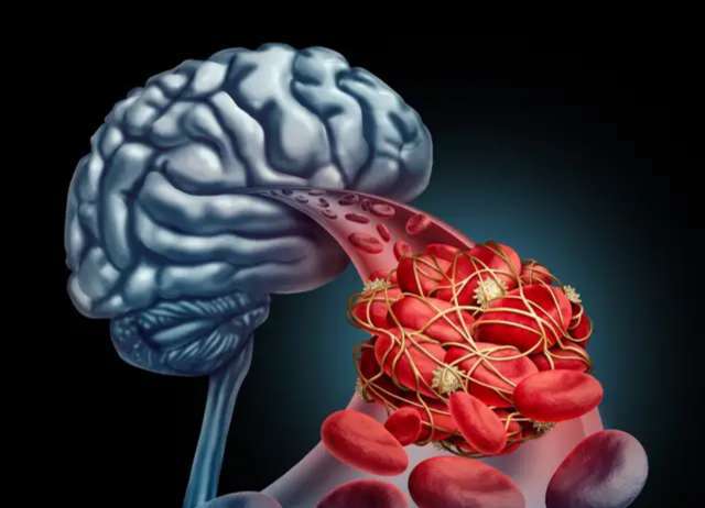 Nhồi máu não đến quá nhanh, nhận biết được 5 triệu chứng bạn sẽ tự cứu sống mình - 1