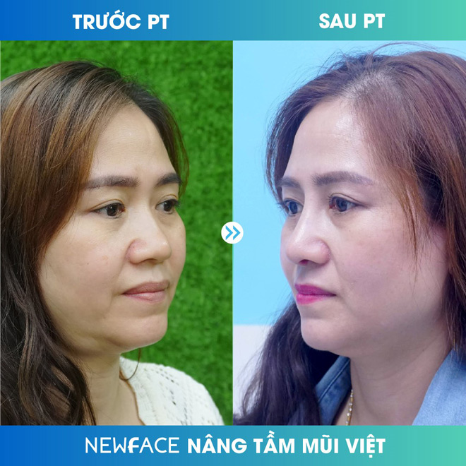 Hé lộ nguyên nhân khiến Việt kiều tìm đến thẩm mỹ viện Newface nâng mũi - 2