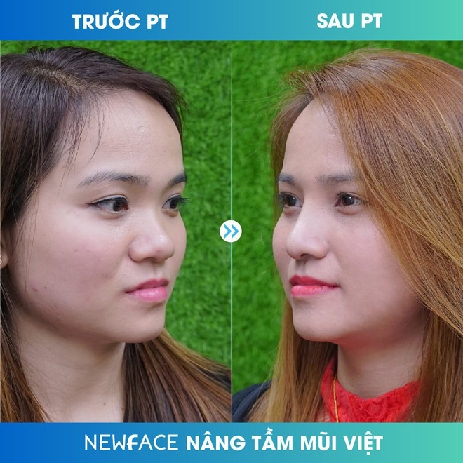 Hé lộ nguyên nhân khiến Việt kiều tìm đến thẩm mỹ viện Newface nâng mũi - 3