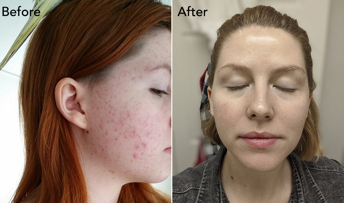 Một phụ nữ cải thiện làn da nhờ phương pháp dưỡng da có thêm axit.