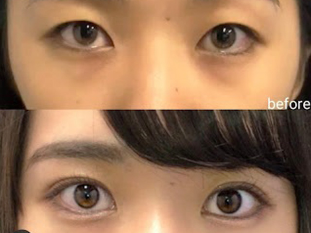 Nhật Bản, Hàn Quốc đi đầu phẫu thuật thẩm mỹ mắt "đường chỉ" thành "bồ câu"
