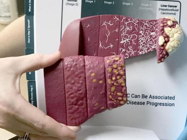 Sức khỏe đời sống - Những dấu hiệu nhỏ nhận biết ung thư gan giai đoạn sớm