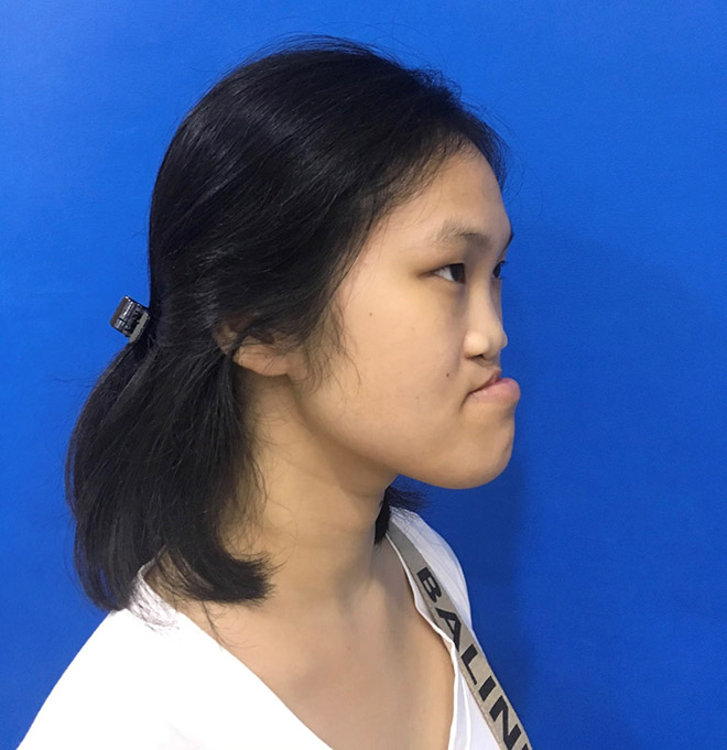 Nguyễn Trang Nhung bị dị tật sứt môi hở hàm ếch bẩm sinh