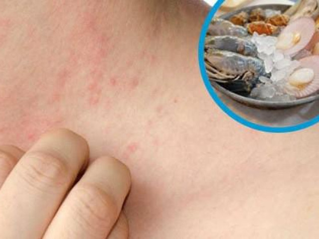 Sức khỏe đời sống - Ham hải sản giá rẻ, nguy kịch vì dị ứng