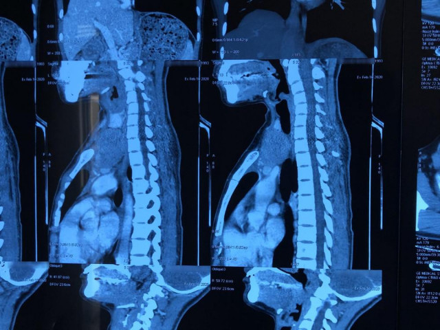 Sức khỏe đời sống - Người phụ nữ Việt Nam bị "u đi lạc", thế giới chỉ vài ca mắc