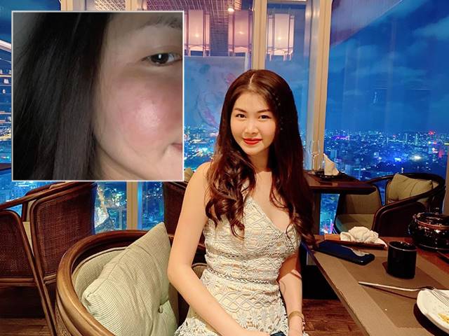 Làm đẹp - Bí mật sau mặt phù nề bị chê thẩm mỹ hỏng của vợ Đăng Khôi