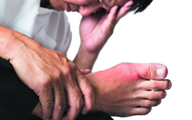 Bệnh gút gây đau đớn dữ dội tại khớp