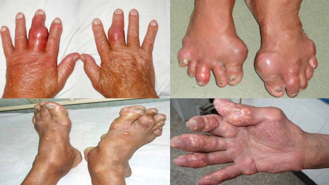 Bệnh gút gây nhiều biến chứng nguy hiểm