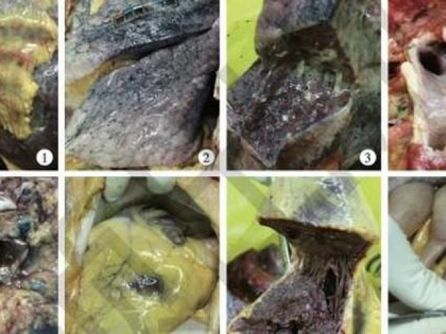 Thế giới - Covid-19 ảnh hưởng lên phổi nhiều nhất