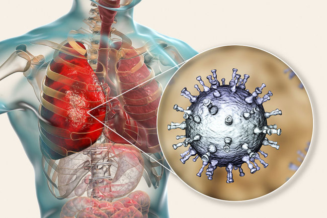 Kết quả khám nghiệm tử thi người nhiễm Covid-19 cho thấy tổn thương nghiêm trọng ở phổi và hệ thống miễn dịch. Ảnh minh họa:&nbsp;VCG/Kateryna Kon