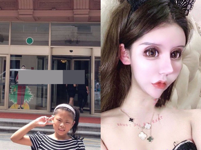 Làm đẹp - Thêm 1 thảm họa "mặt rắn" ở Trung Quốc, 13 tuổi phẫu thuật 60 lần suốt 3 năm