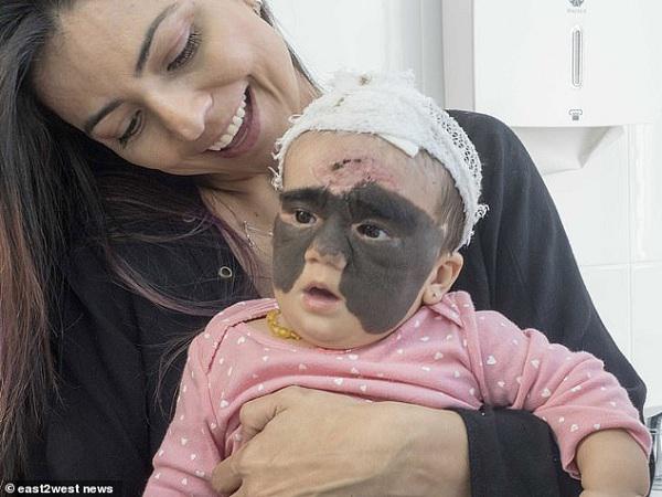 Con gái chào đời với vết bớt đen khổng lồ trên mặt, bố mẹ làm một hành động khiến ai cũng "cứng họng" - 3