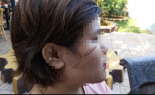 Vết sẹo trên mặt của nữ công nhân, ảnh: T.V