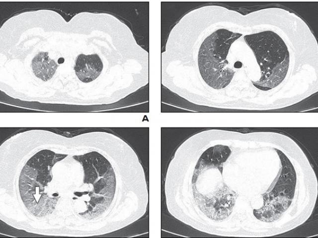 Hình ảnh phổi của bệnh nhân nhiễm Covid-19 bị virus Corona tàn phá