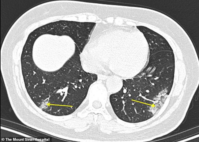Hình ảnh phổi của bệnh nhân nhiễm Covid-19 bị virus Corona tàn phá - 4
