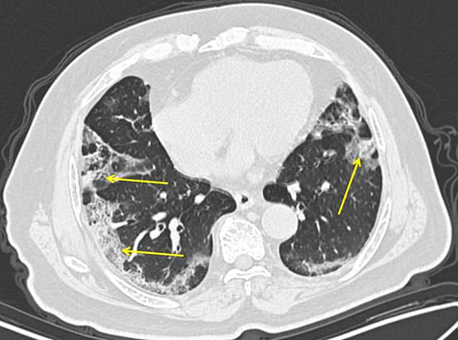 Hình ảnh phổi của bệnh nhân nhiễm Covid-19 bị virus Corona tàn phá - 5