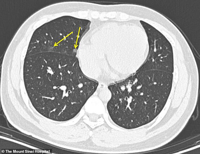 Hình ảnh phổi của bệnh nhân nhiễm Covid-19 bị virus Corona tàn phá - 6