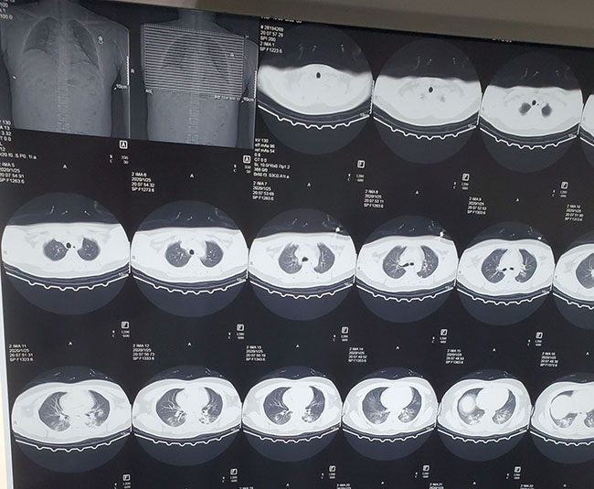 Hình ảnh phổi của bệnh nhân nhiễm Covid-19 bị virus Corona tàn phá - 8
