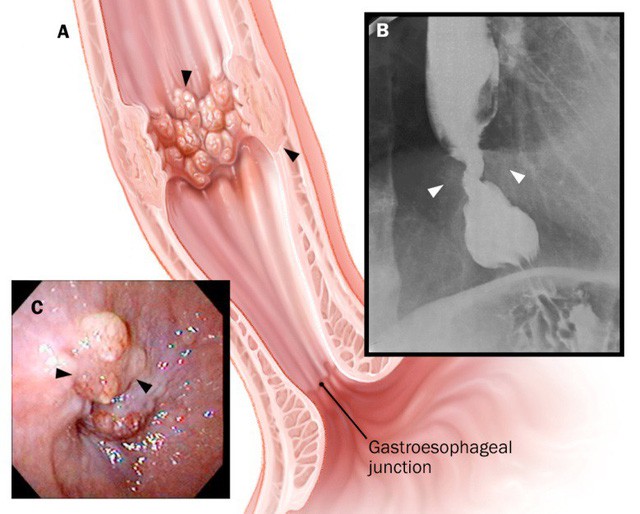 Nuốt nghẹn dấu hiệu cảnh báo ung thư thực quản.