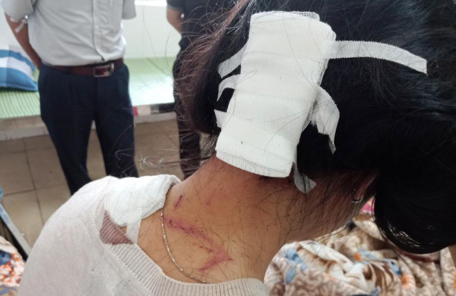 Các vết thương ở vùng đầu và vai của nạn nhân do "chồng hờ" của mẹ gây ra