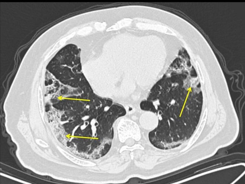 Hình ảnh chụp CT cho thấy Covid-19 tấn công phổi người bệnh (ảnh: Bloomberg)