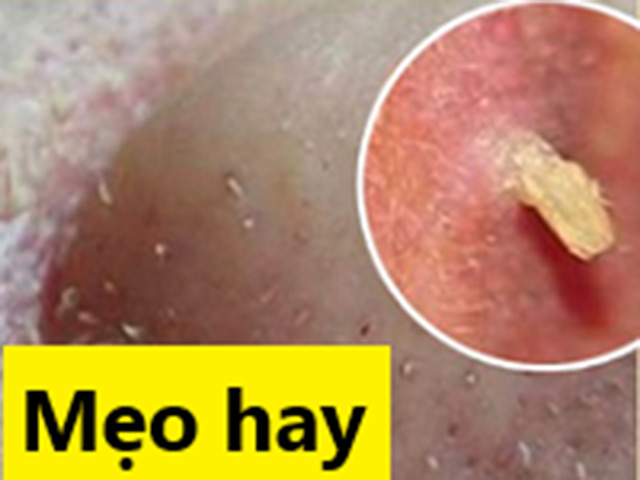 Tin tức sức khỏe - Mụn đầu đen, đầu trắng, mụn ẩn, mụn li ti: Tự động trồi nhân, mịn sạch nhờ 1 bước này mỗi tối!