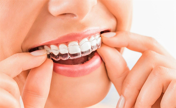 Niềng răng là gì? Niềng răng có đau không và những lưu ý bạn nên biết - 8