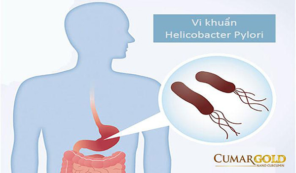 Vi khuẩn HP: Nguyên nhân, triệu chứng và cách xử lý - 1