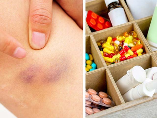 Sức khỏe đời sống - Nếu hay bị các vết bầm tím không rõ lý do thì có thể bạn bị các bệnh này