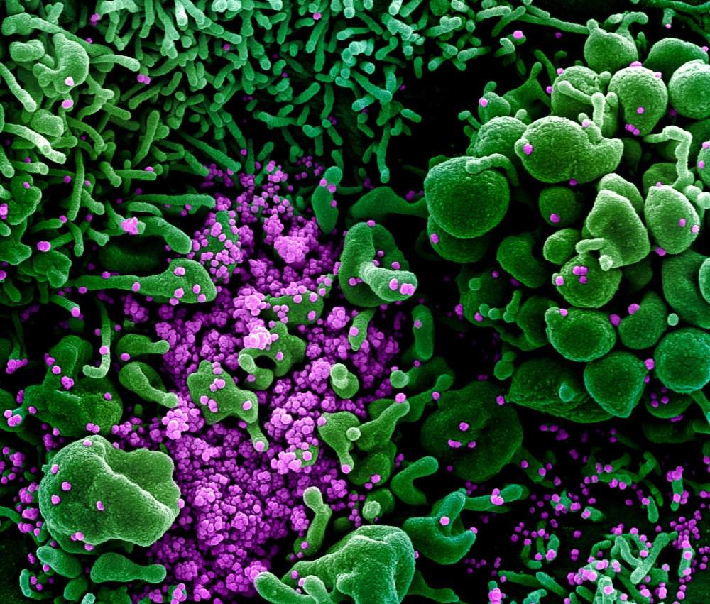 Virus Corona được tô màu tím, bám chặt vào tế bào người màu xanh.