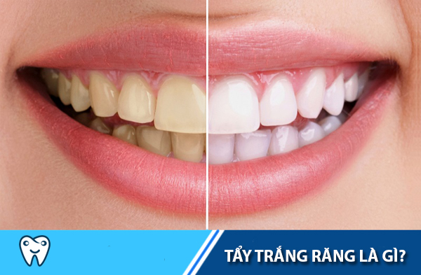 Tẩy trắng răng có đau và gây hại ảnh hưởng  tới sức khỏe không? - 1