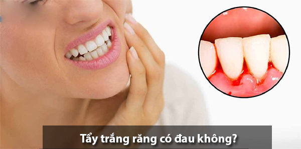 Tẩy trắng răng có đau và gây hại ảnh hưởng  tới sức khỏe không? - 7