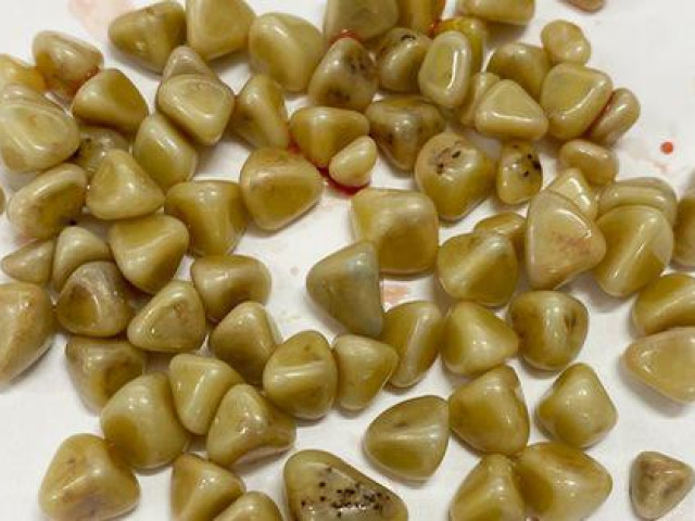 Sức khỏe đời sống - Ớn lạnh túi đá chứa hàng trăm chiếc "răng người" trong bụng 1 phụ nữ