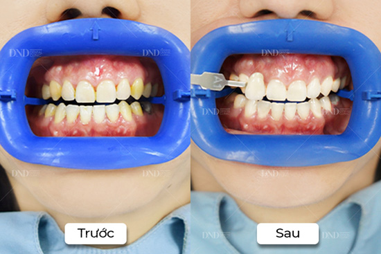 3 phương pháp làm trắng răng “cấp tốc” cho bạn tự tin mỉm cười đón Tết - 1
