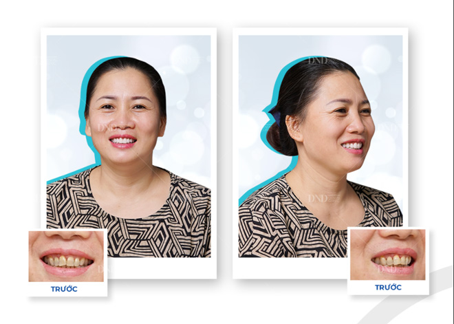 3 phương pháp làm trắng răng “cấp tốc” cho bạn tự tin mỉm cười đón Tết - 2