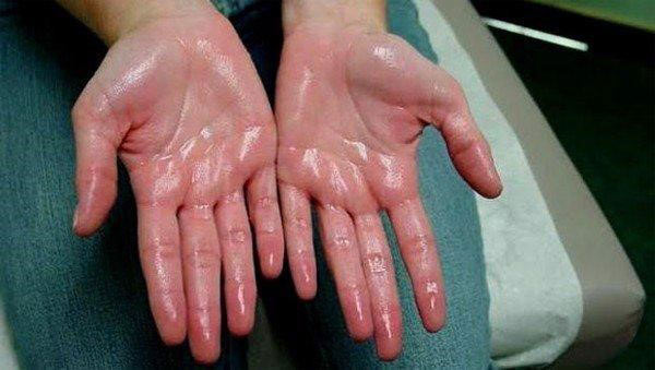 Bệnh tăng tiết mồ hôi ảnh hưởng nghiêm trọng đến cuộc sống của nhiều người