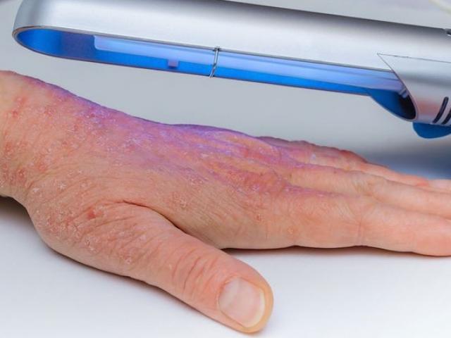 Sức khỏe đời sống - 7 mẹo làm căn bệnh vẩy nến bớt nghiêm trọng, mọi người đừng nên bỏ qua