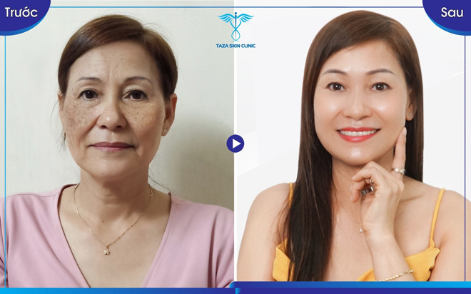 Taza Skin Clinic: Thương hiệu thẩm mỹ uy tín 6 năm đồng hành cùng nhan sắc Việt - 5