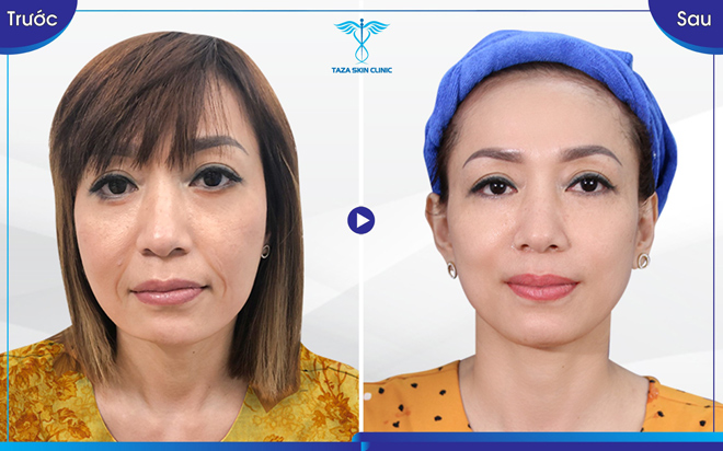 Taza Skin Clinic: Thương hiệu thẩm mỹ uy tín 6 năm đồng hành cùng nhan sắc Việt - 3
