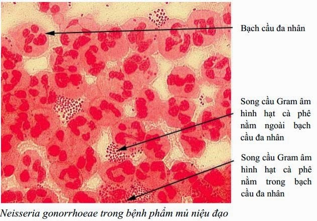 Nhiều nam giới mắc bệnh lậu, bác sĩ chỉ rõ thủ phạm - 3