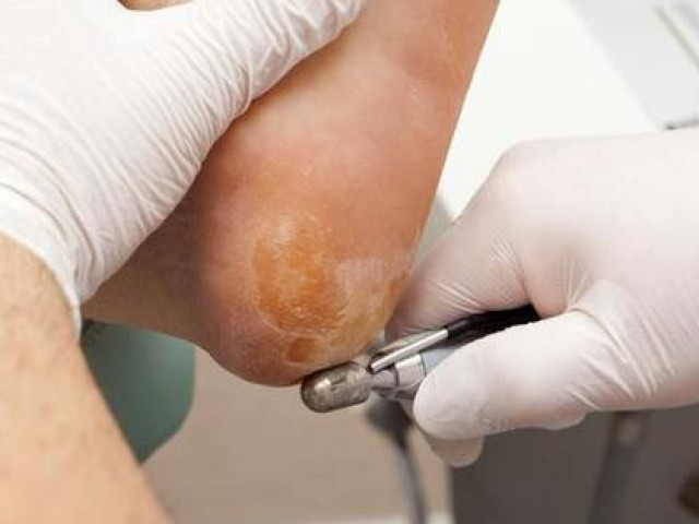 Sức khỏe đời sống - Gót chân thường xuyên bị khô và nứt nẻ, coi chừng sức khỏe đang “kêu cứu”