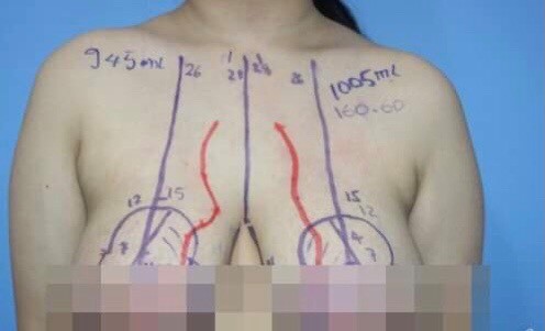 Nữ sinh lớp 8 có vòng ngực to gấp 4 lần người lớn - 1