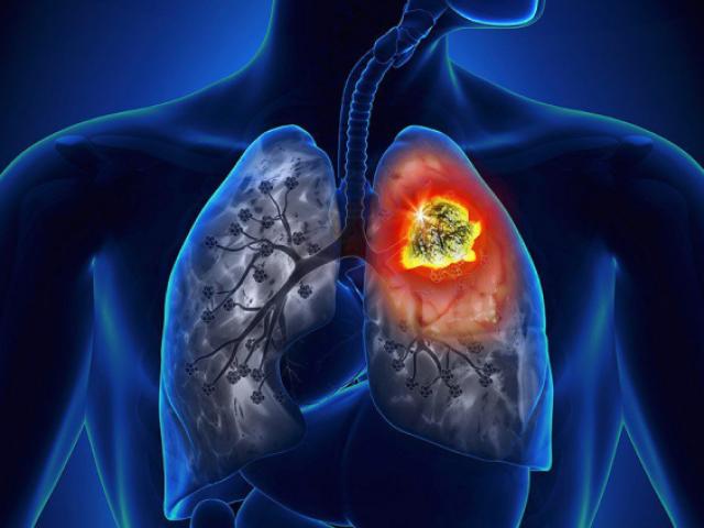 Sức khỏe đời sống - Hai vợ chồng cùng mắc ung thư phổi: bàn tay phát "tín hiệu" lạ nhưng không để ý