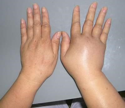 Hai vợ chồng cùng mắc ung thư phổi: bàn tay phát "tín hiệu" lạ nhưng không để ý - 6
